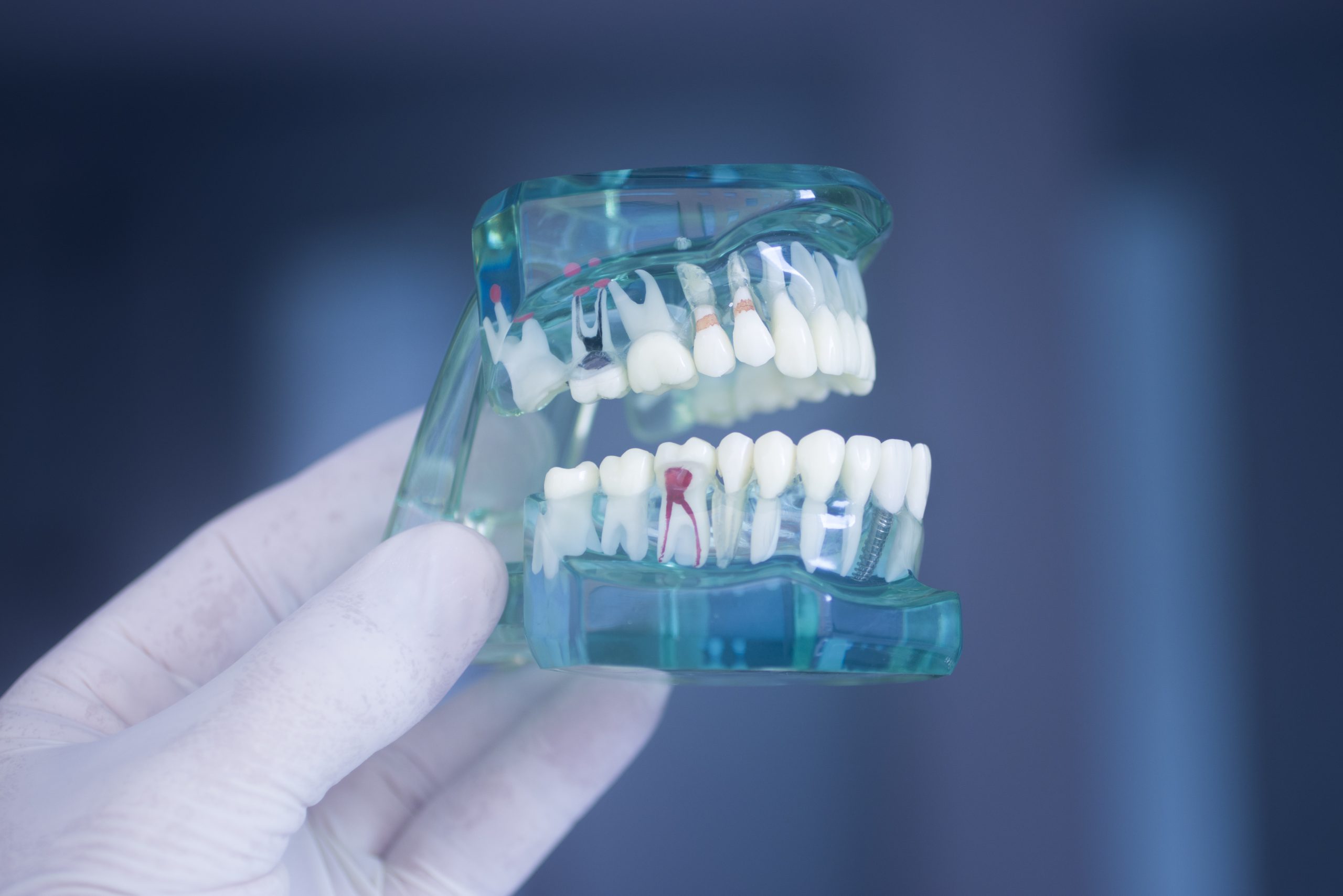 A Root Canal Could Save Infected Teeth Brighton, MA