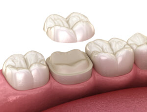 brighton dental crown