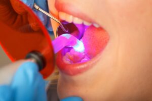 brighton dental fillings