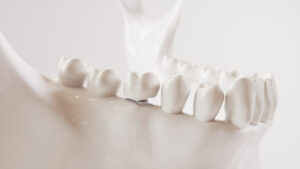 brighton dental implants