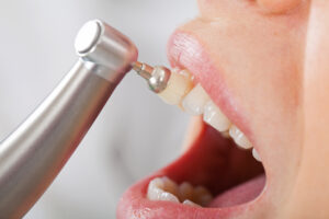 brighton dental cleaning