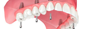 brighton dental implants