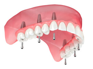 brighton dental implants