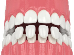 brighton veneers