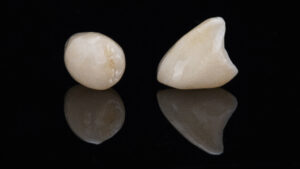 brighton dental crowns