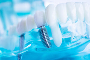 brighton dental implants