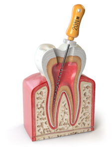brighton root canal