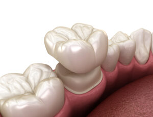 brighton dental crowns