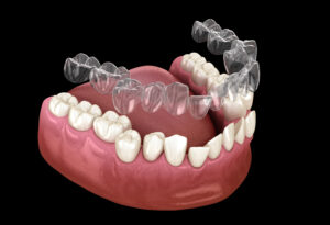 brighton invisalign