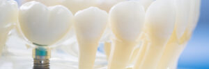 brighton dental implants