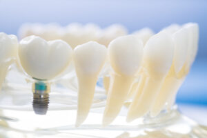 brighton dental implants