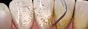 brighton periodontal cleaning