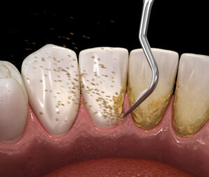 brighton periodontal cleaning
