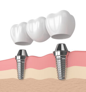 brighton dental bridges