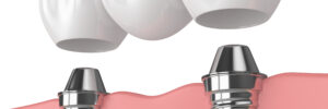brighton dental bridges