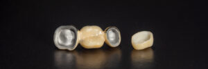 brighton dental crowns