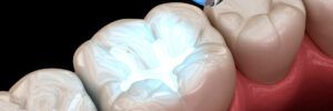 brighton dental fillings
