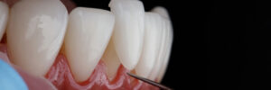 brighton veneers