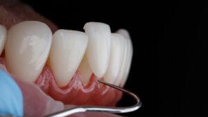 brighton veneers
